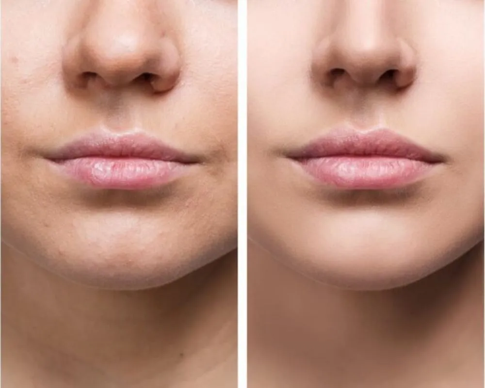 lip-fillers